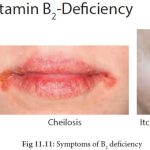 Riboflavin Deficiency