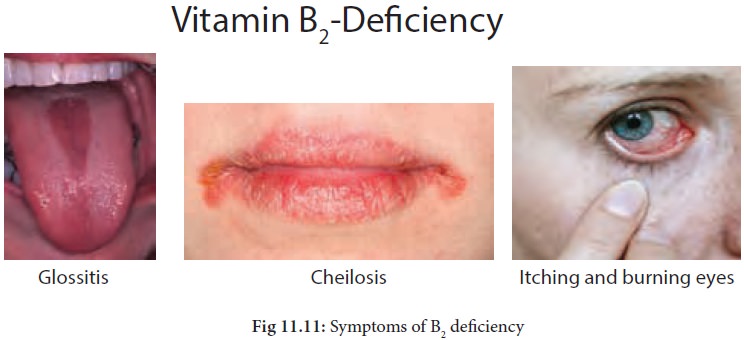 Riboflavin Deficiency