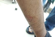 बाइक सवार युवक पर तेंदुए से संघर्ष का सनसनीखेज दावा, तेंदुए को भगाकर युवक अस्पताल में भर्ती